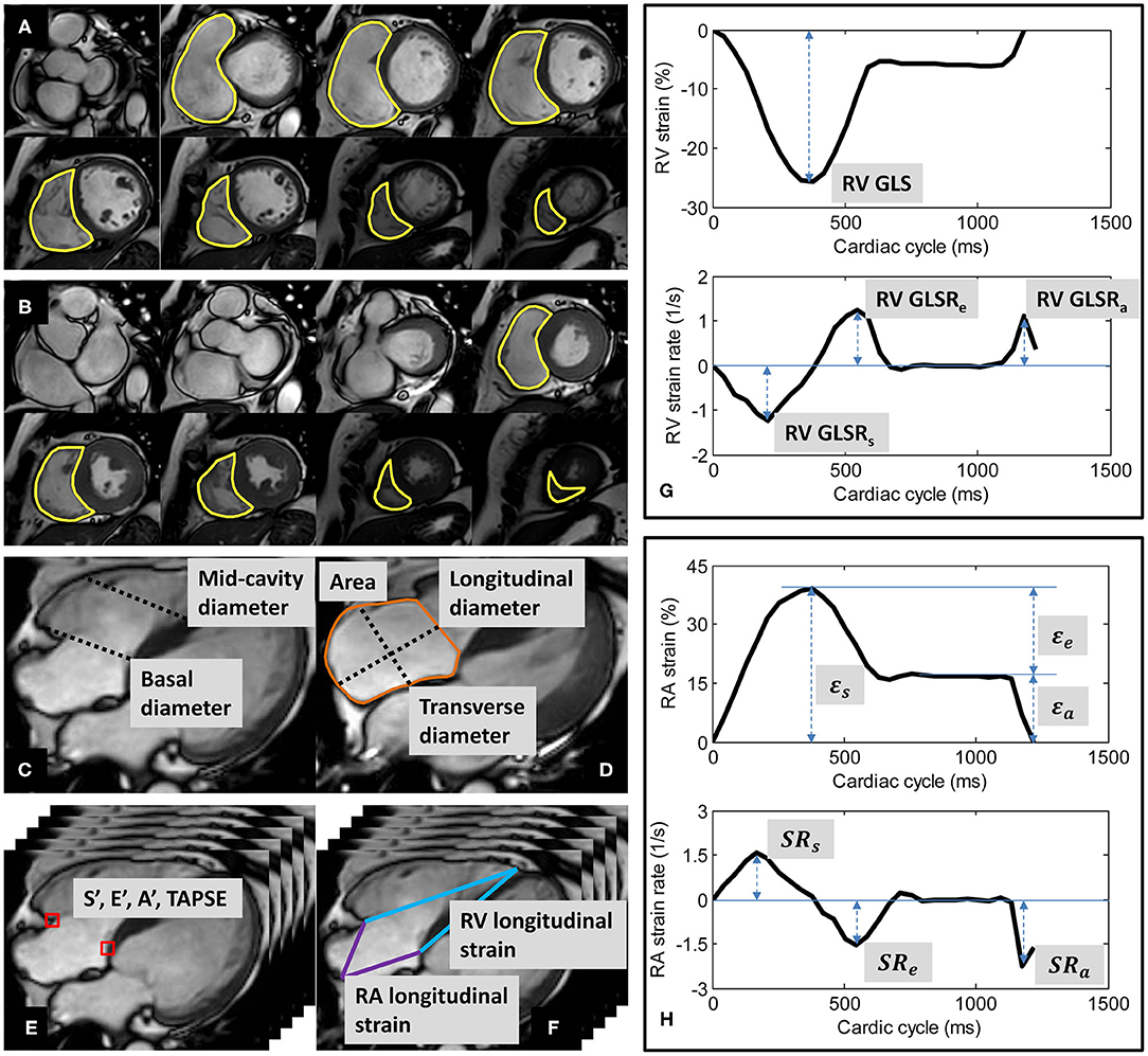 MRI-Derived Myocardial Strain Measures in Normal Subjects