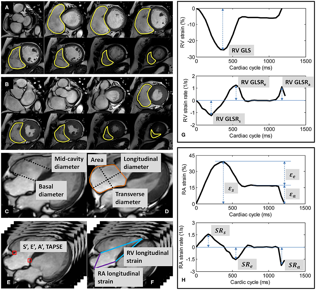 2- and 3-Dimensional Myocardial Strain in Cardiac Health and