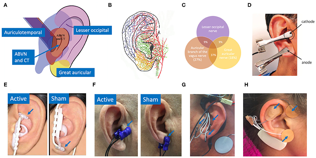 Transcutaneous auricular vagus nerve stimulation as a potential novel  treatment for polycystic ovary syndrome