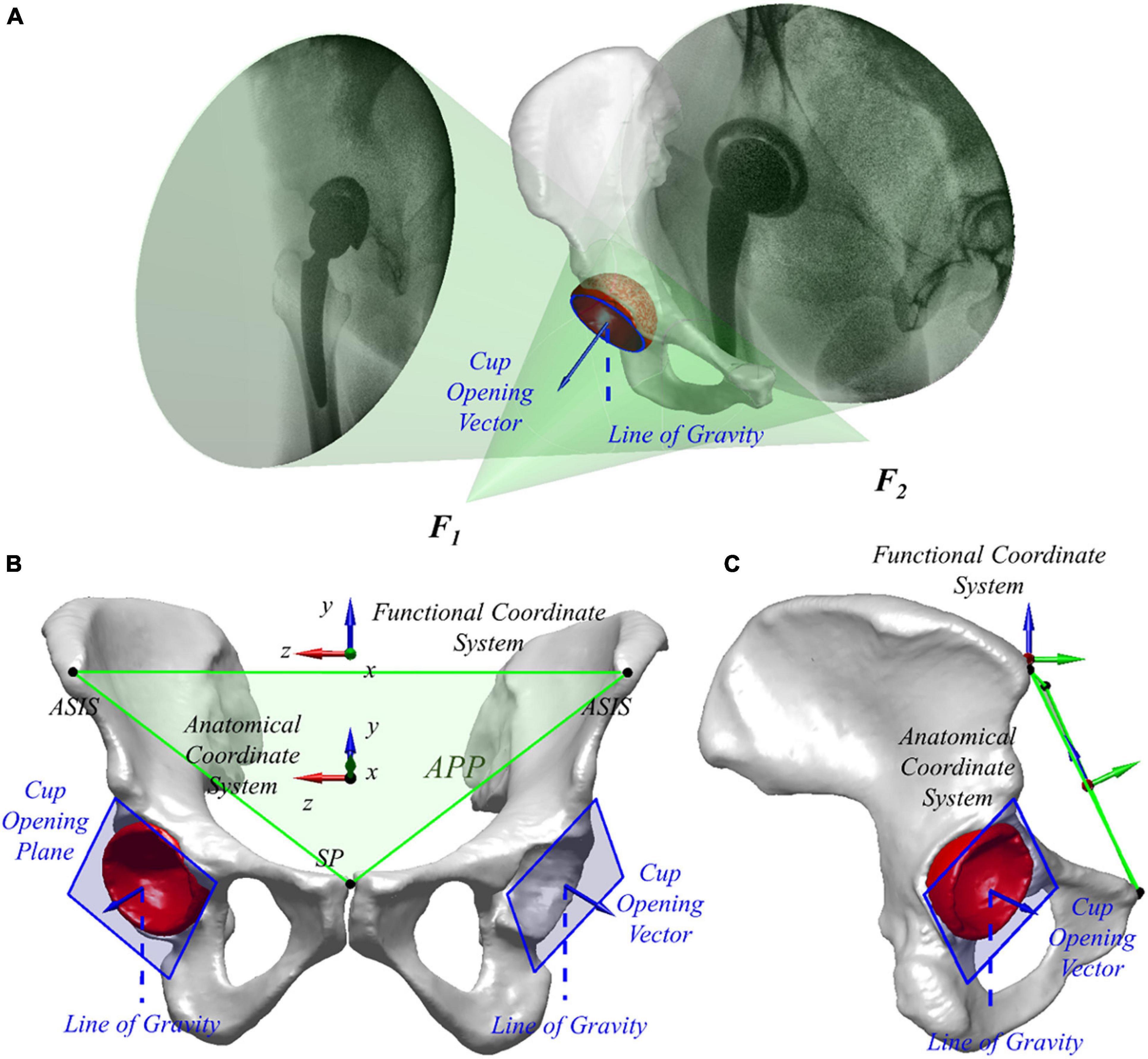 Frontiers  Well-Placed Acetabular Component Oriented Outside the Safe Zone  During Weight-Bearing Daily Activities