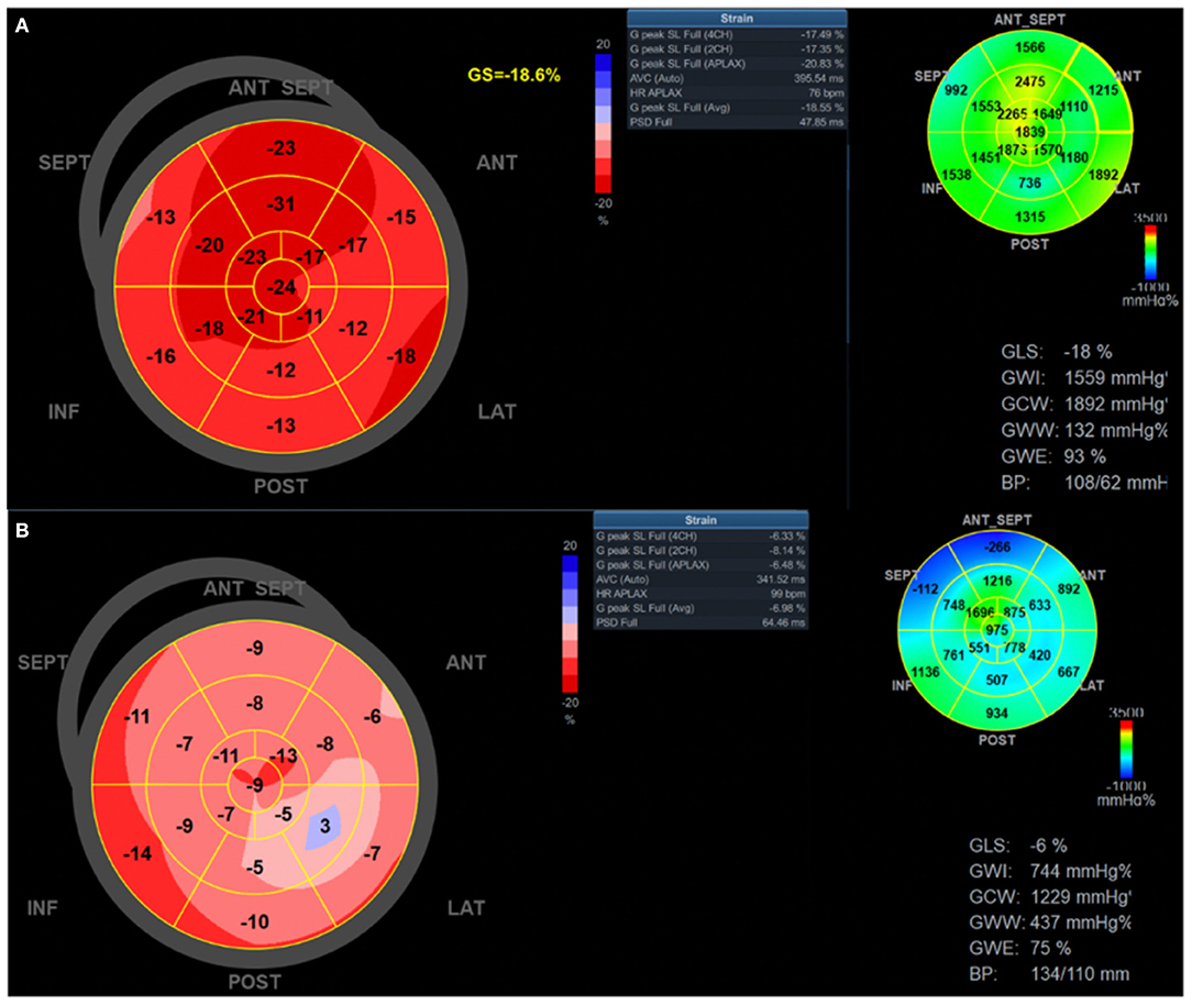 Evaluation of Subclinical LV Systolic Dysfunction by GLS Using 2D-STE