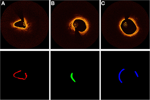 Frontiers  Characteristics and evaluation of atherosclerotic plaques: an  overview of state-of-the-art techniques