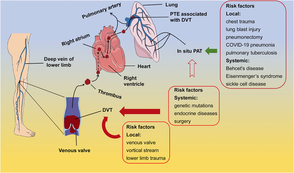 Frontiers In Situ Pulmonary Artery Thrombosis A Previously