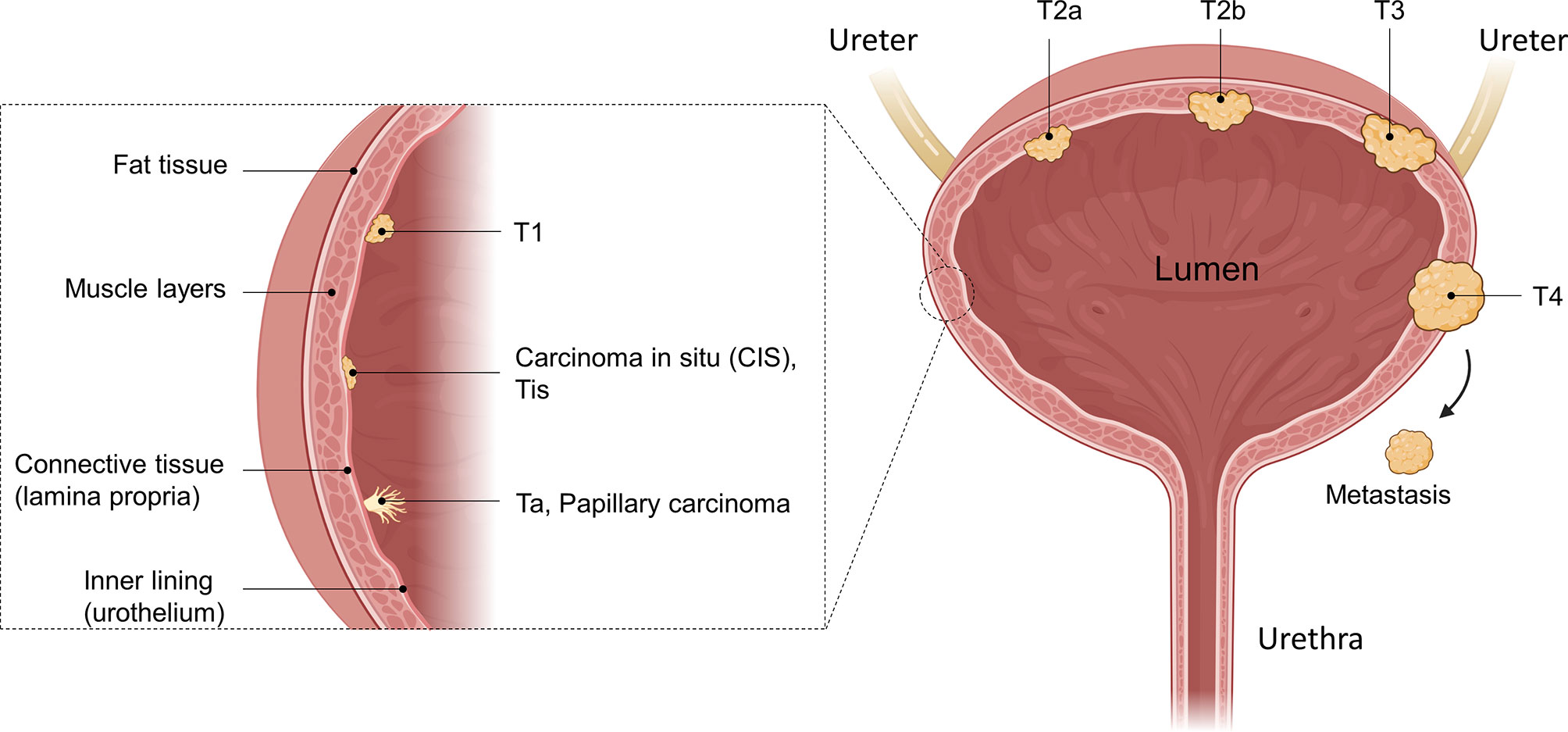 Bladder Cancer - Z Urology