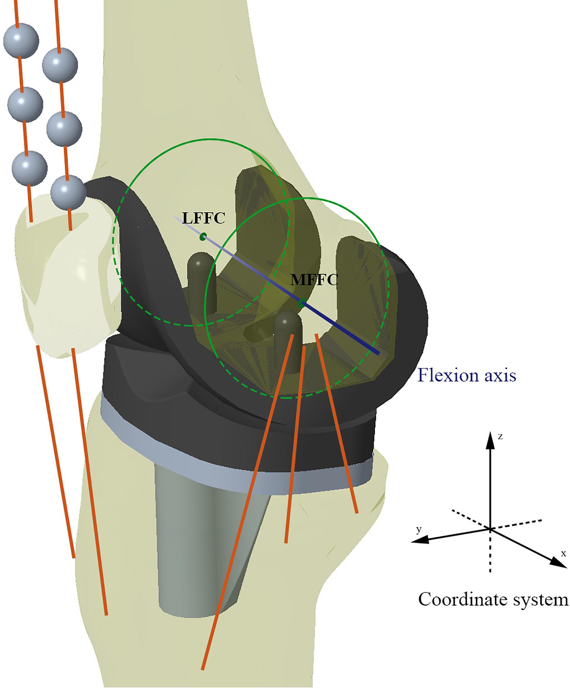 Influence of intentional femoral component flexion in navigated