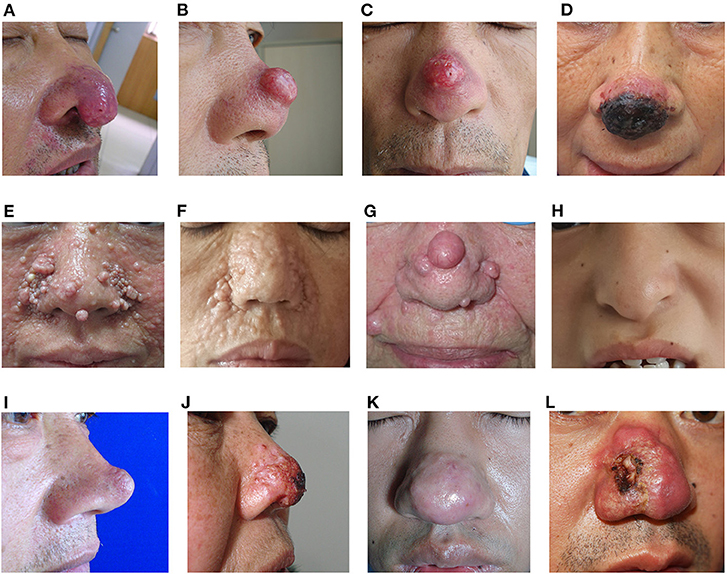 Nose cancer cheap