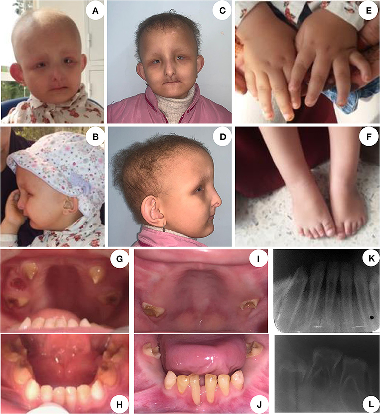 Frontiers | A Novel Homozygous Variant in GJA1 Causing a