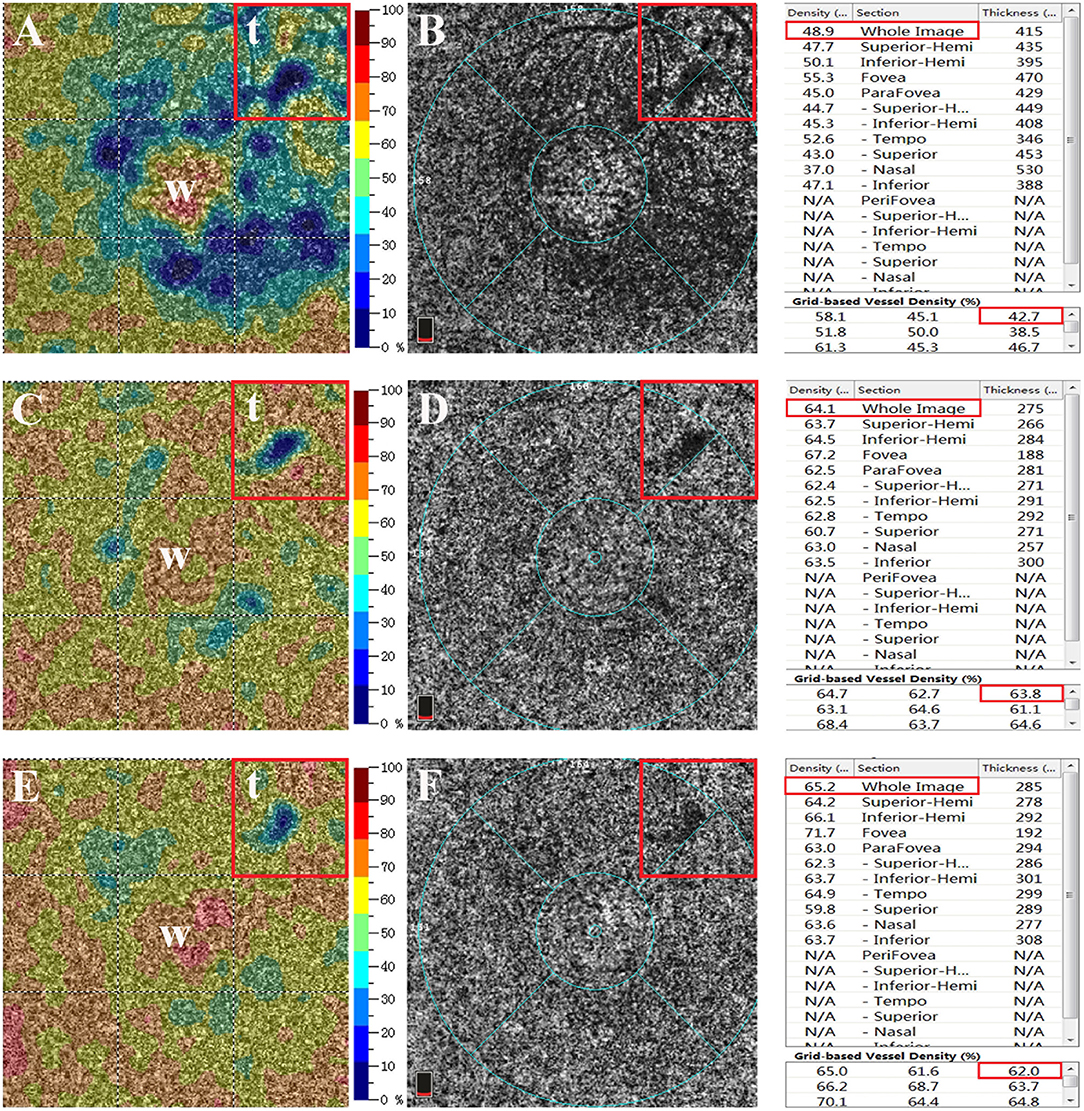 Frontiers | Choriocapillaris Ischemia at the Leakage Point Frontiers | Choriocapillaris Ischemia at the Leakage Point