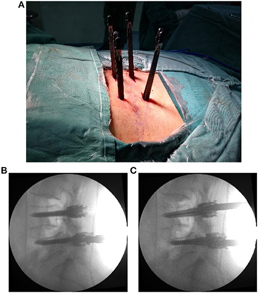 Endoscopic vs. Open Back Surgery