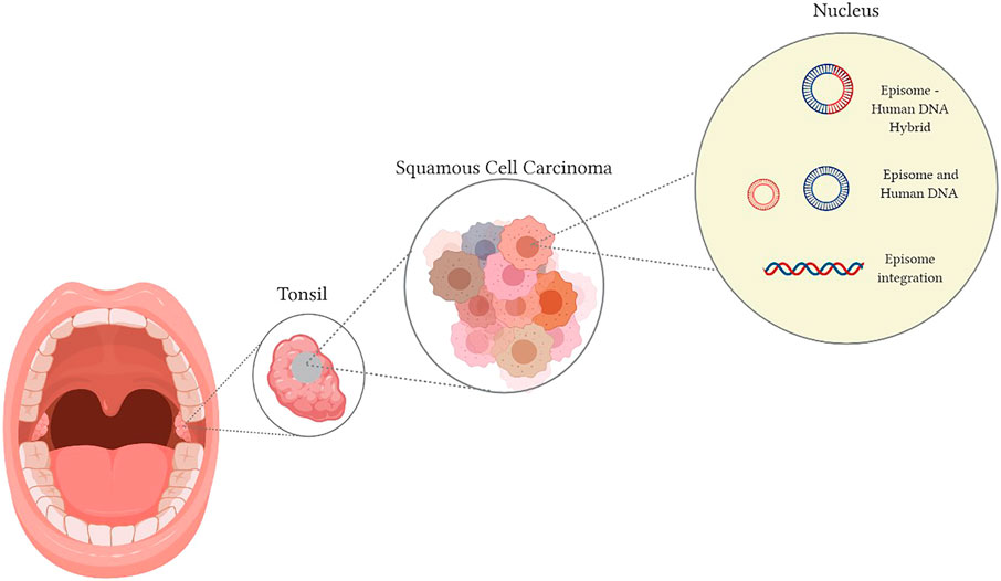 Lesioni papilloma virus bocca - terapiesicoaching.ro Lesioni da papilloma virus