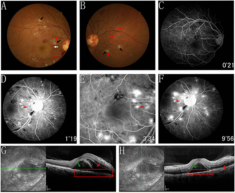 Frontiers | Acute Hypertensive Retinochoroidopathy Secondary to an  Anti-cancer Drug (apatinib): The First Case Report