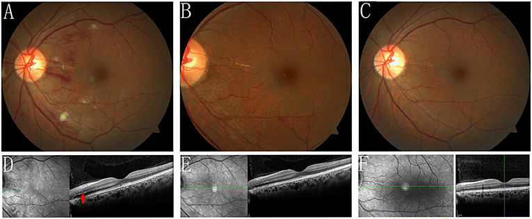 Frontiers | Acute Hypertensive Retinochoroidopathy Secondary to an  Anti-cancer Drug (apatinib): The First Case Report