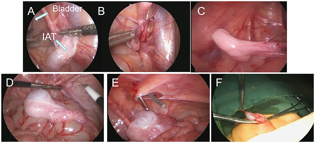 Frontiers | Comparison of Two Types of Staged Laparoscopic Orchiopexy