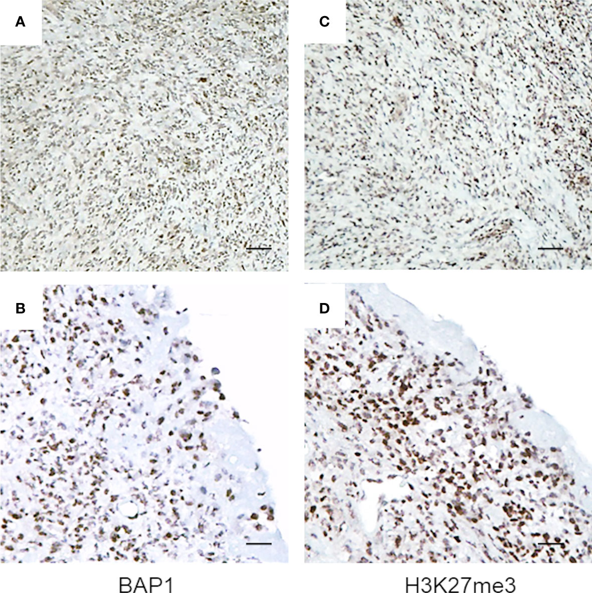 Frontiers Cdkn2a Determines Mesothelioma Cell Fate To Ezh2 Inhibition Oncology