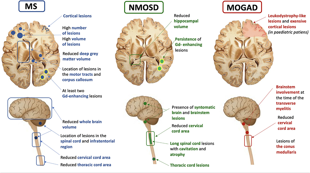 Frontiers Mri Prognostic Factors In Multiple Sclerosis Neuromyelitis