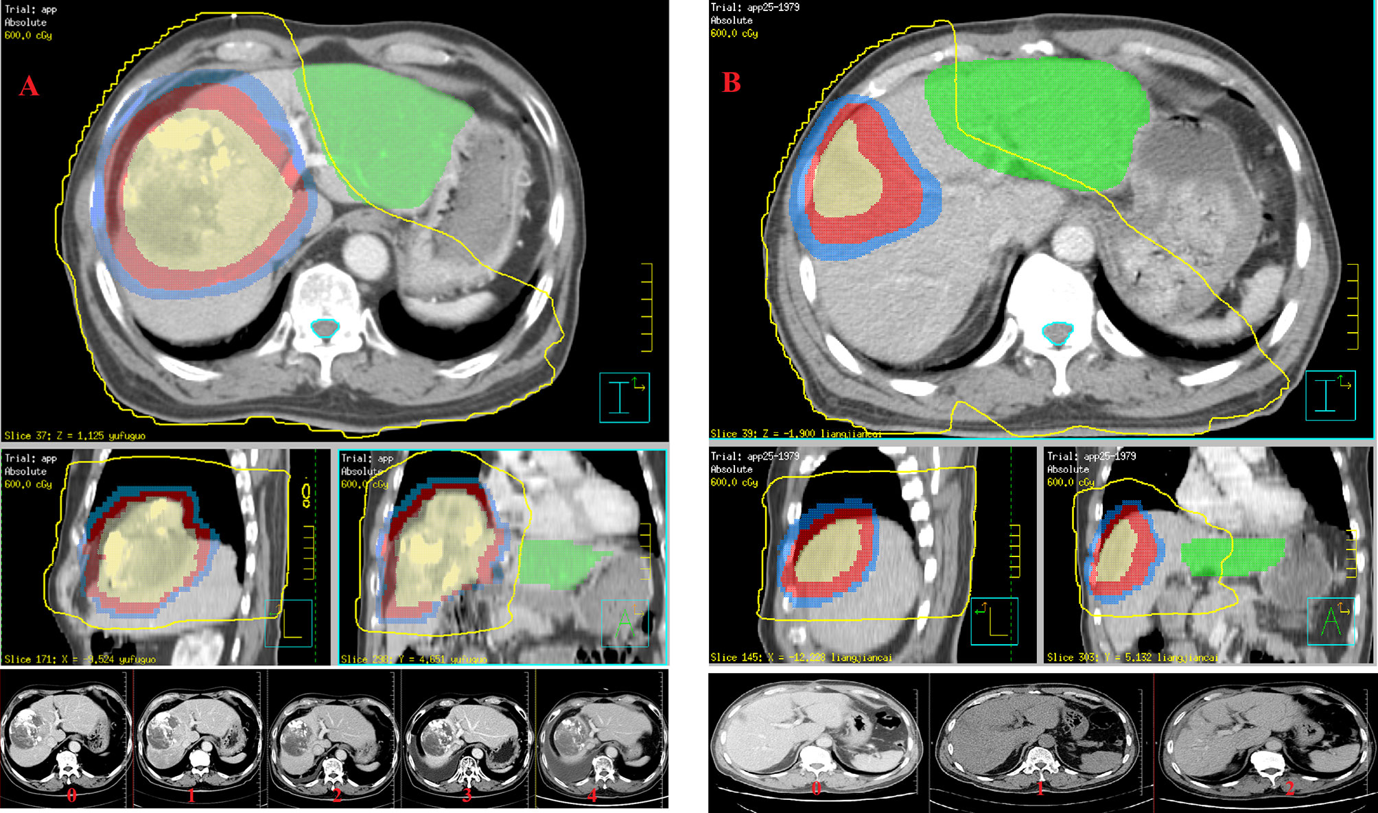 Impact of Neuroradiology-Based Peer Review on Head and Neck Radiotherapy  Target Delineation