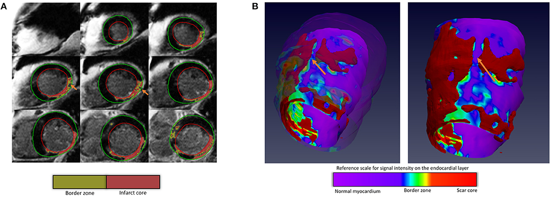 Direct mitral regurgitation quantification in hypertrophic cardiomyopathy  using 4D flow CMR jet tracking: evaluation in comparison to conventional  CMR, Journal of Cardiovascular Magnetic Resonance