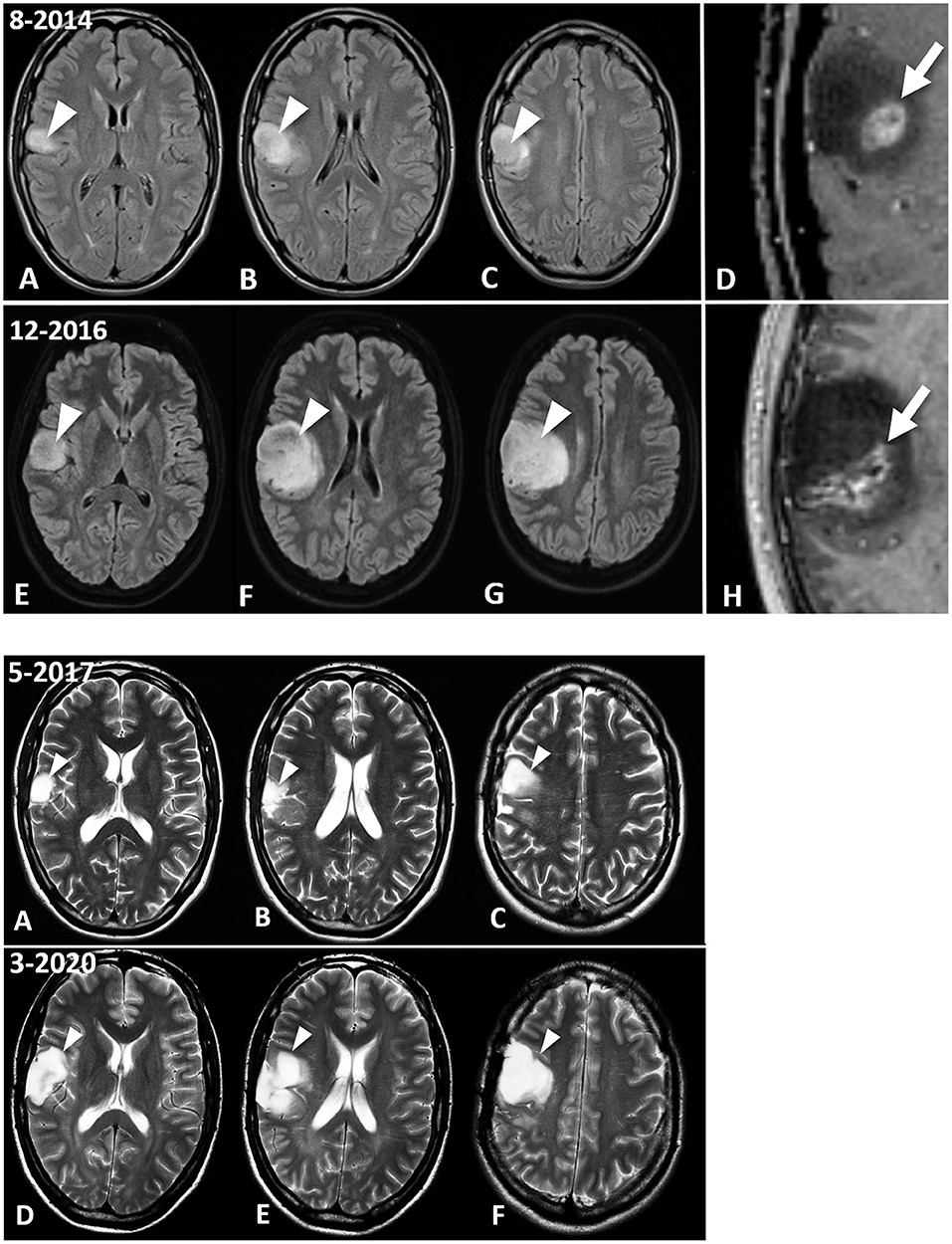 Baszucki Brain Research Fund Backs First Clinical Pilot Trials of Ketogenic  Metabolic Interventions for Mental Health Conditions in Nearly 60 Years