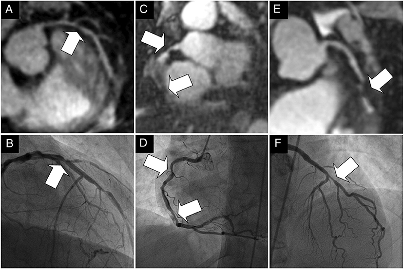 Contrast Media with and without Calcium for Cardioangiography in