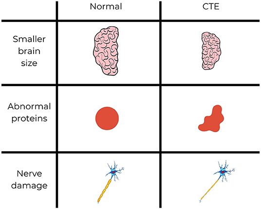 Figure 2 - Chronic traumatic encephalopathy (CTE) is a long-term condition that results from repeated head injuries.