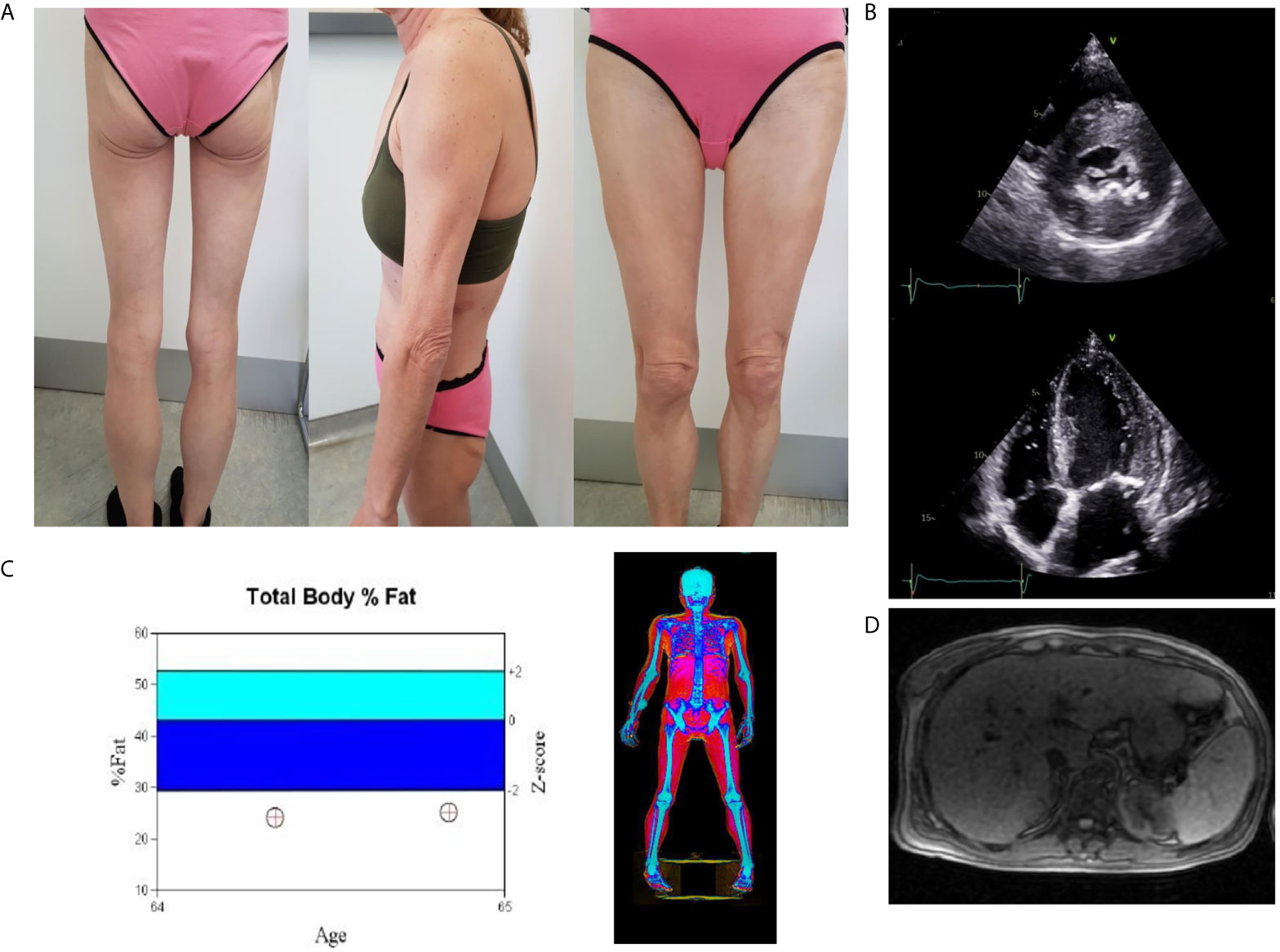Липодистрофия. DXA Patient Hip rotation.