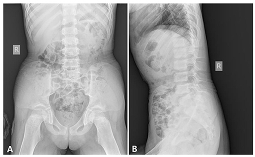 Craniometaphyseal dysplasia radiology