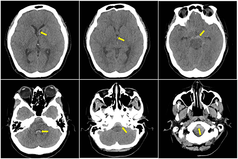 Subarachnoid hemorrhage  Radiology Reference Article