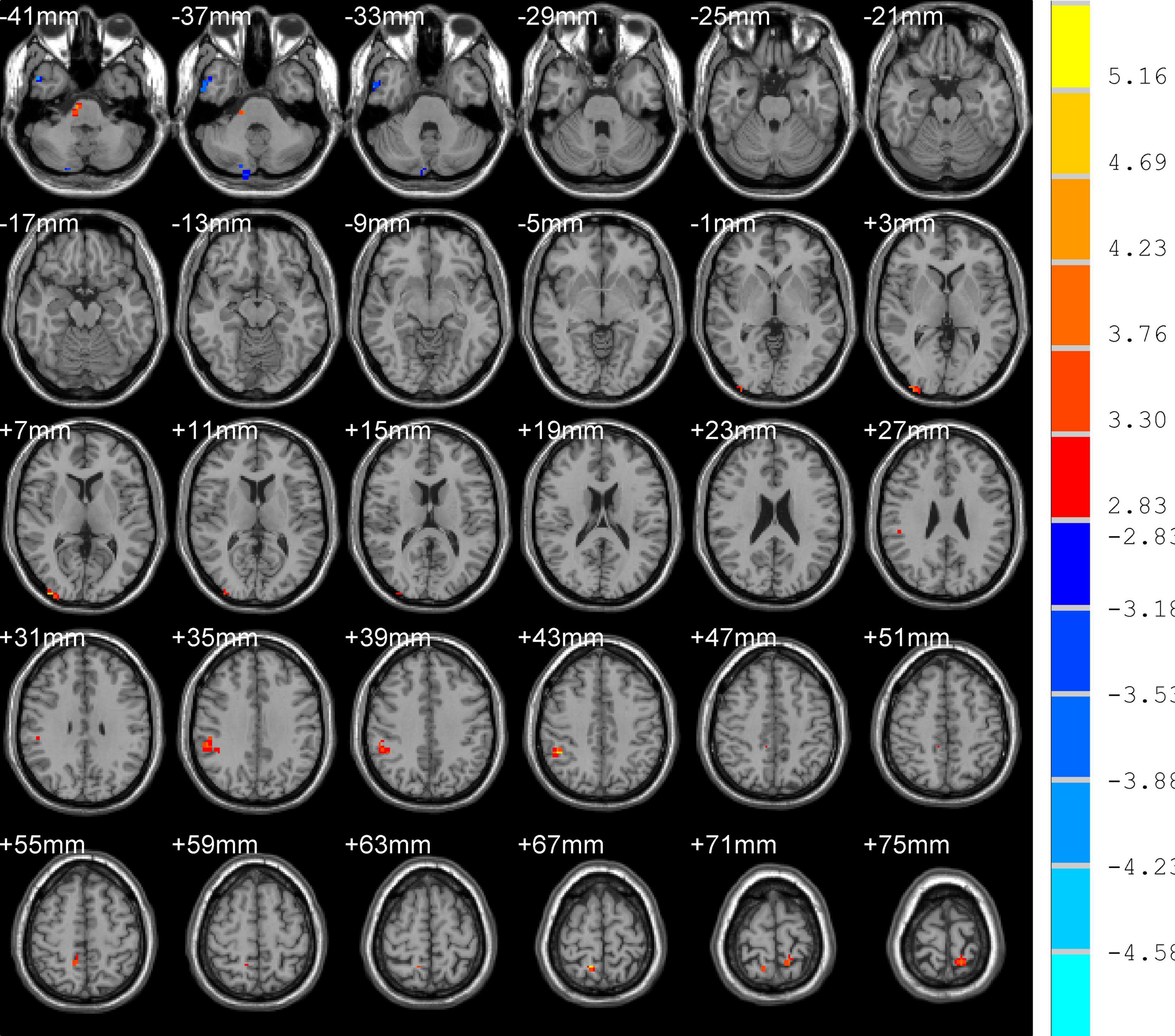 Frontiers | The Effect of Abnormal Regional Homogeneity and 