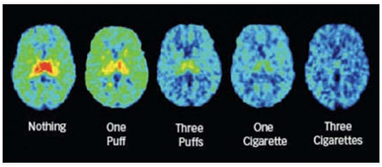 Figure 2 - These brain scan images show the activity of brain cells after increasing doses of nicotine are inhaled from regular cigarettes.