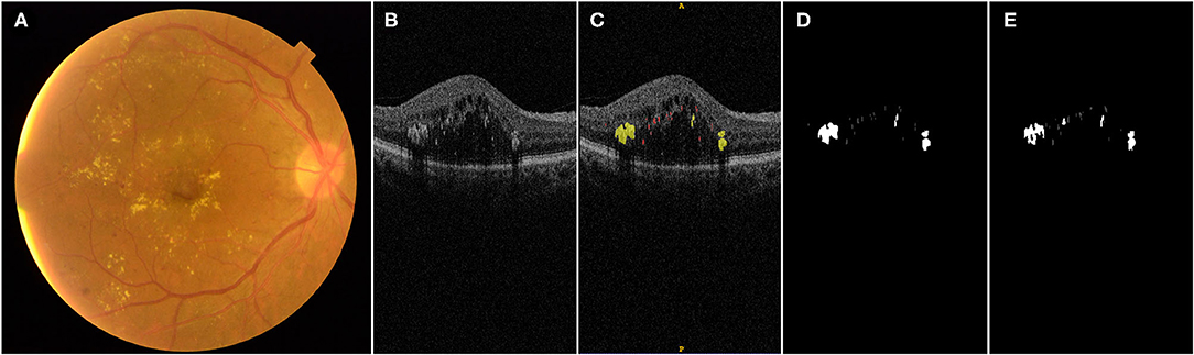 diabetic macular edema