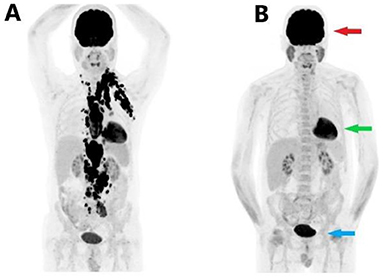 Figure 3 - (A) PET scan of a man with cancer [4].