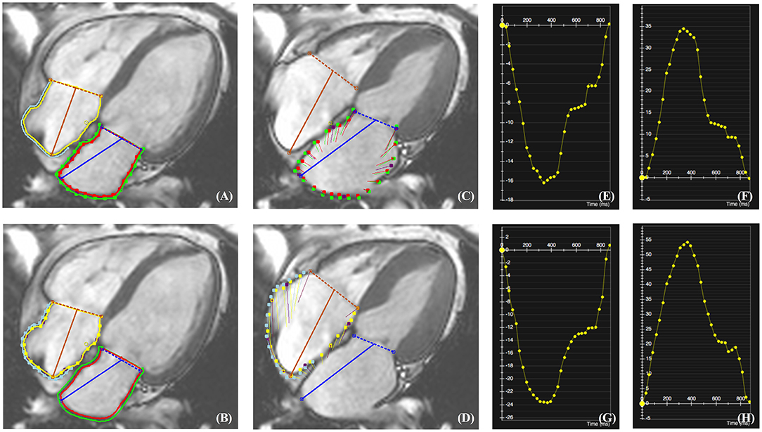 Analysis of myocardial strain of the left ventricle based on 2-D