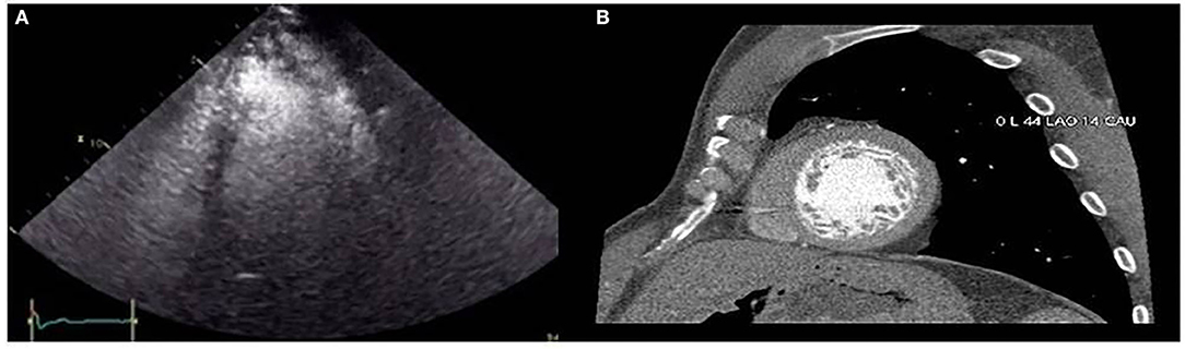 Frontiers | Case Report: A Novel NKX2-5 Mutation in a Family