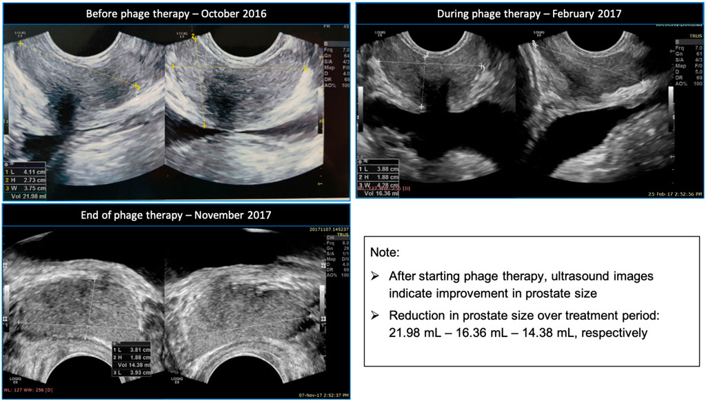 chronic prostatitis medscape