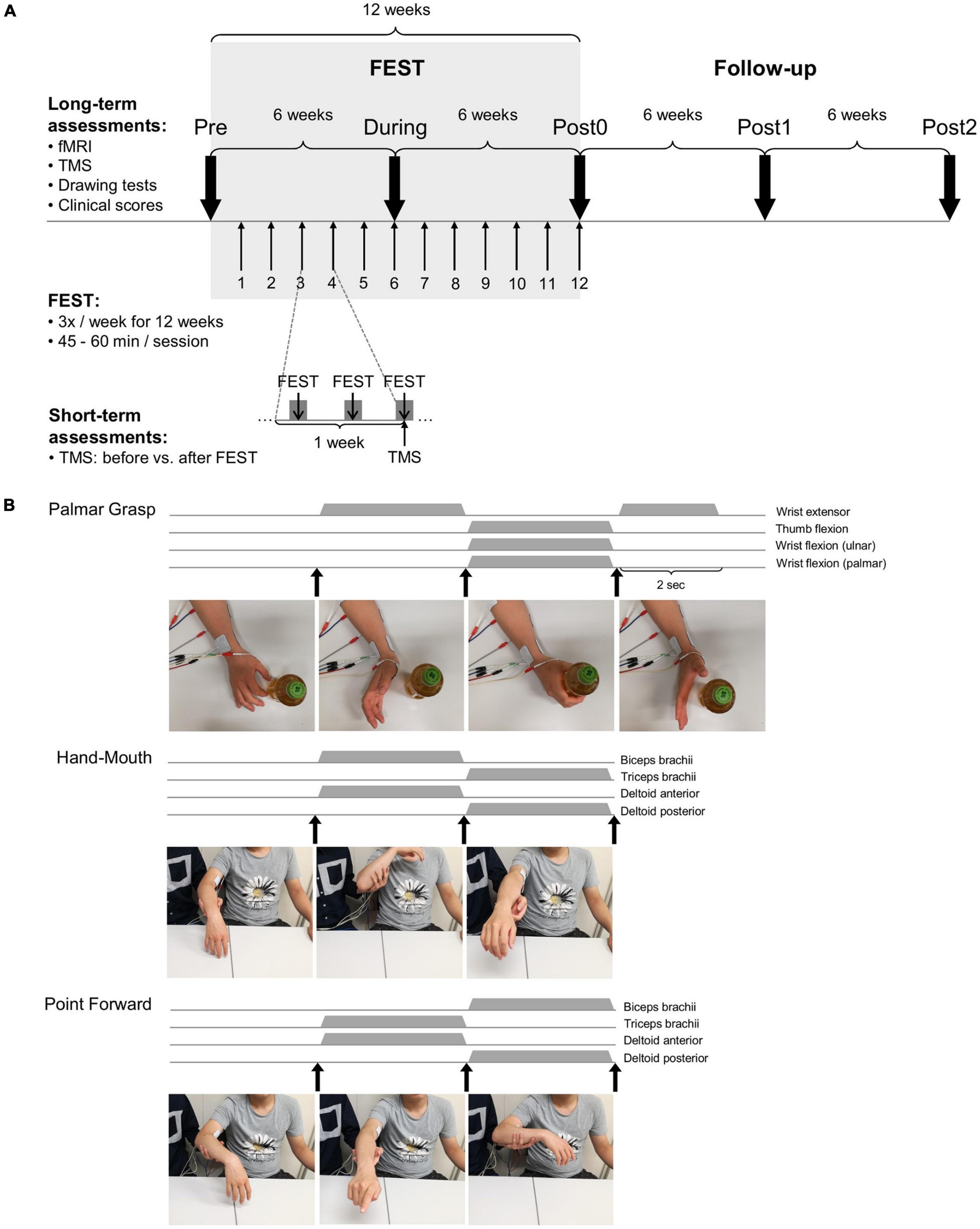 Later anterior deltoid head Electrode Placement for Compex Muscle