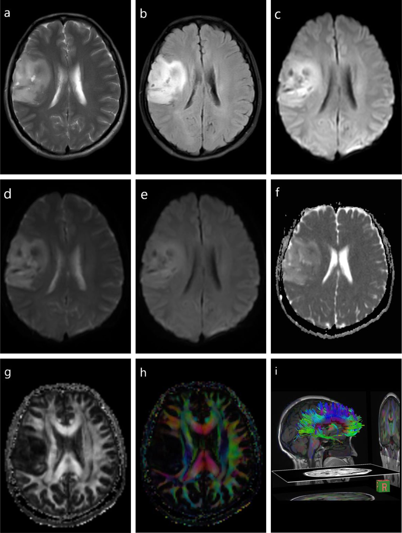 brain mri scan tumor