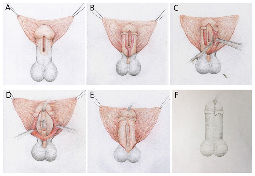 Phimosis - Centre d'urologie Urovar