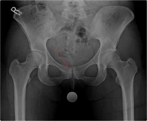 Hip microinstability in cam-type FAIS