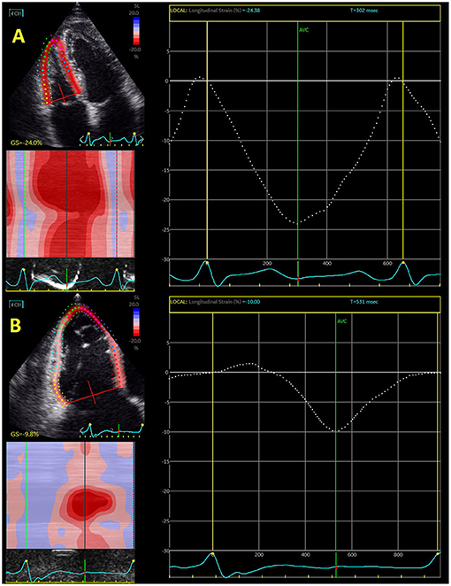 lv strain echo