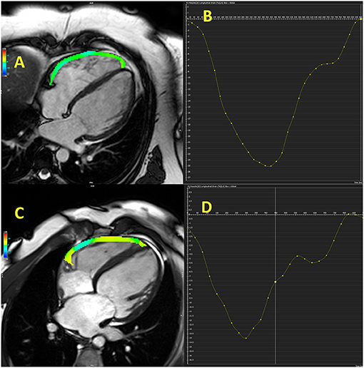 SPECKLE TRACKING RV GLOBAL LONGITUDINAL STRAIN FOR PREDICTION OF PULMONARY  HYPERTENSION - Canadian Journal of Cardiology