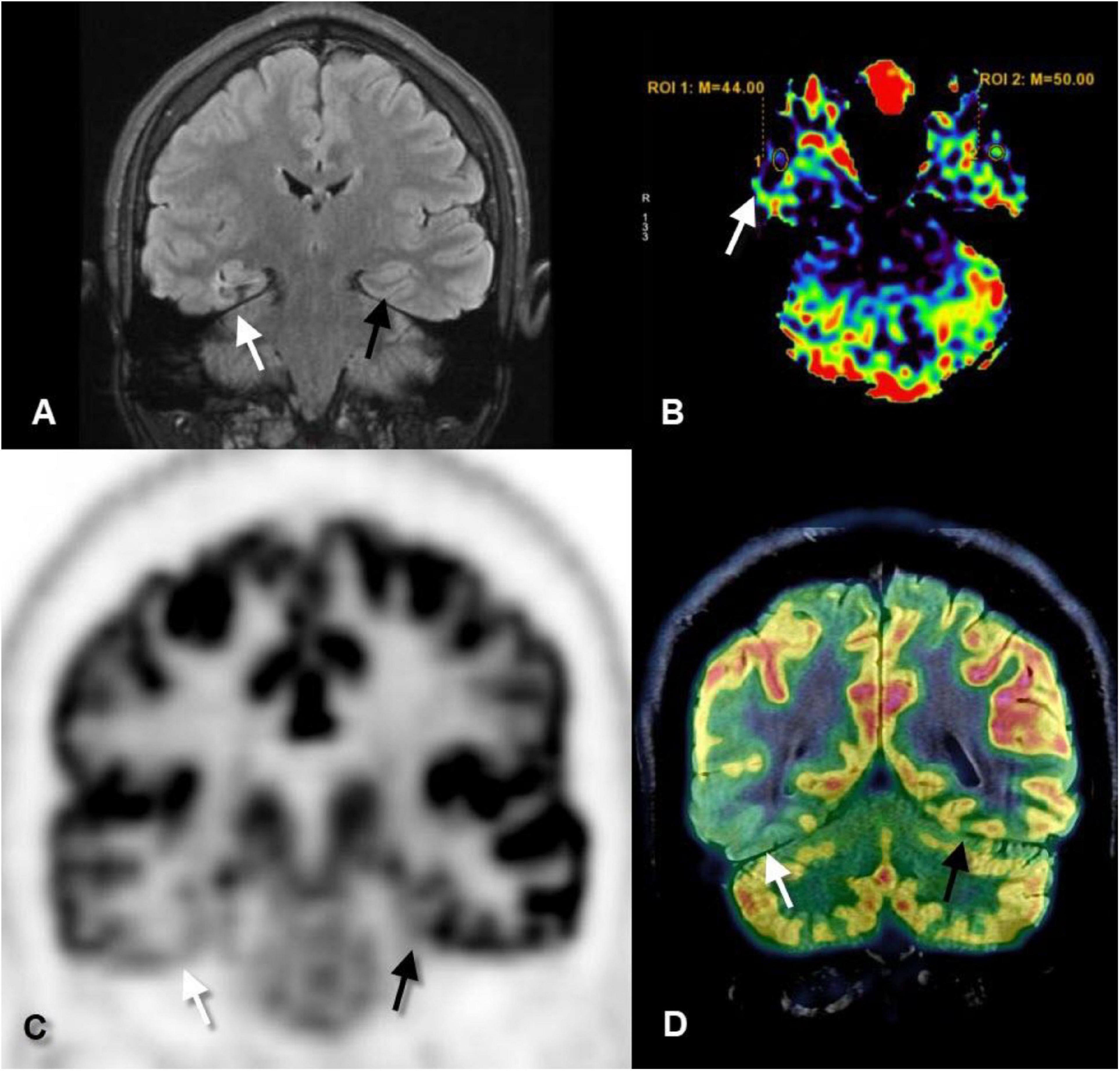 brain pet scan epilepsy