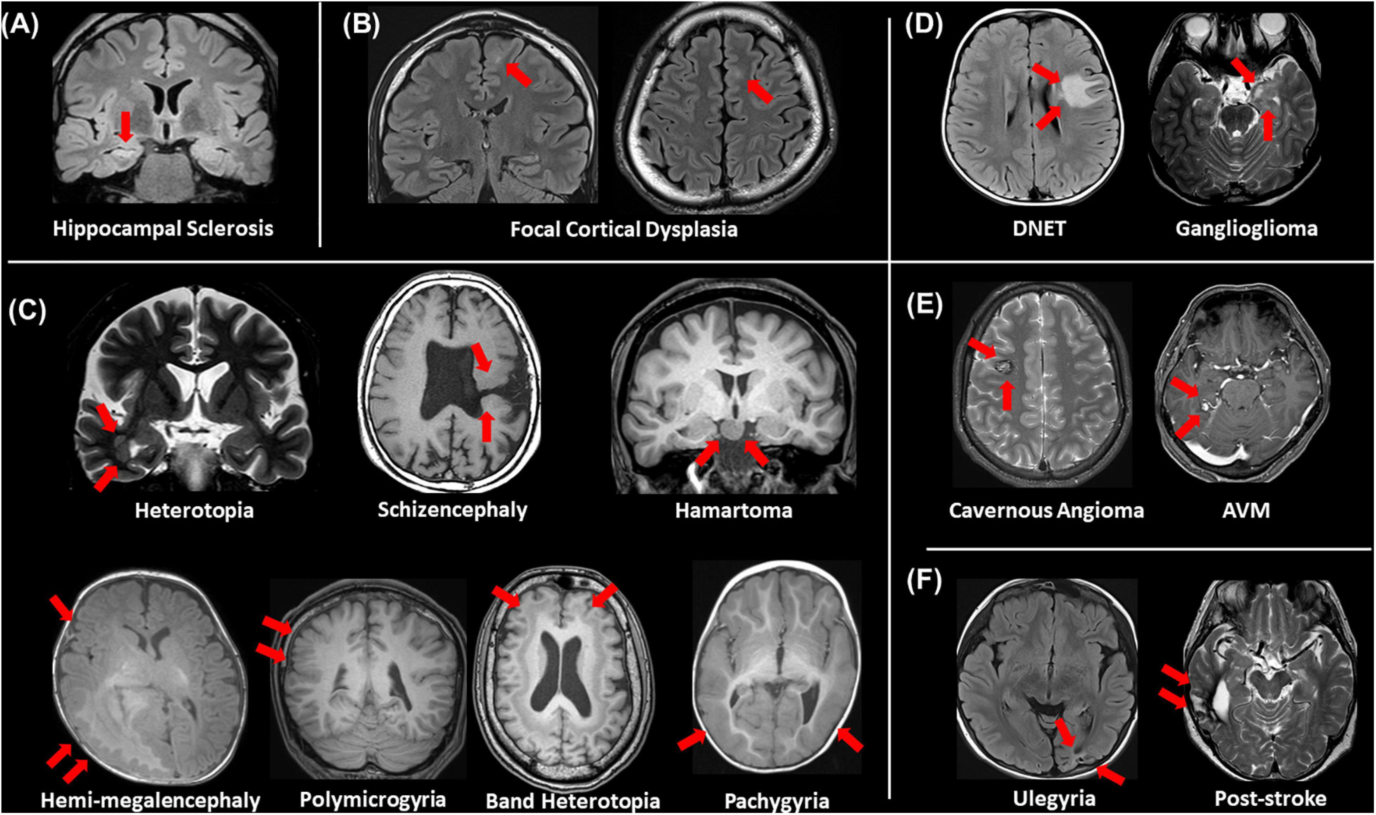 Epilepsy Brain Damage