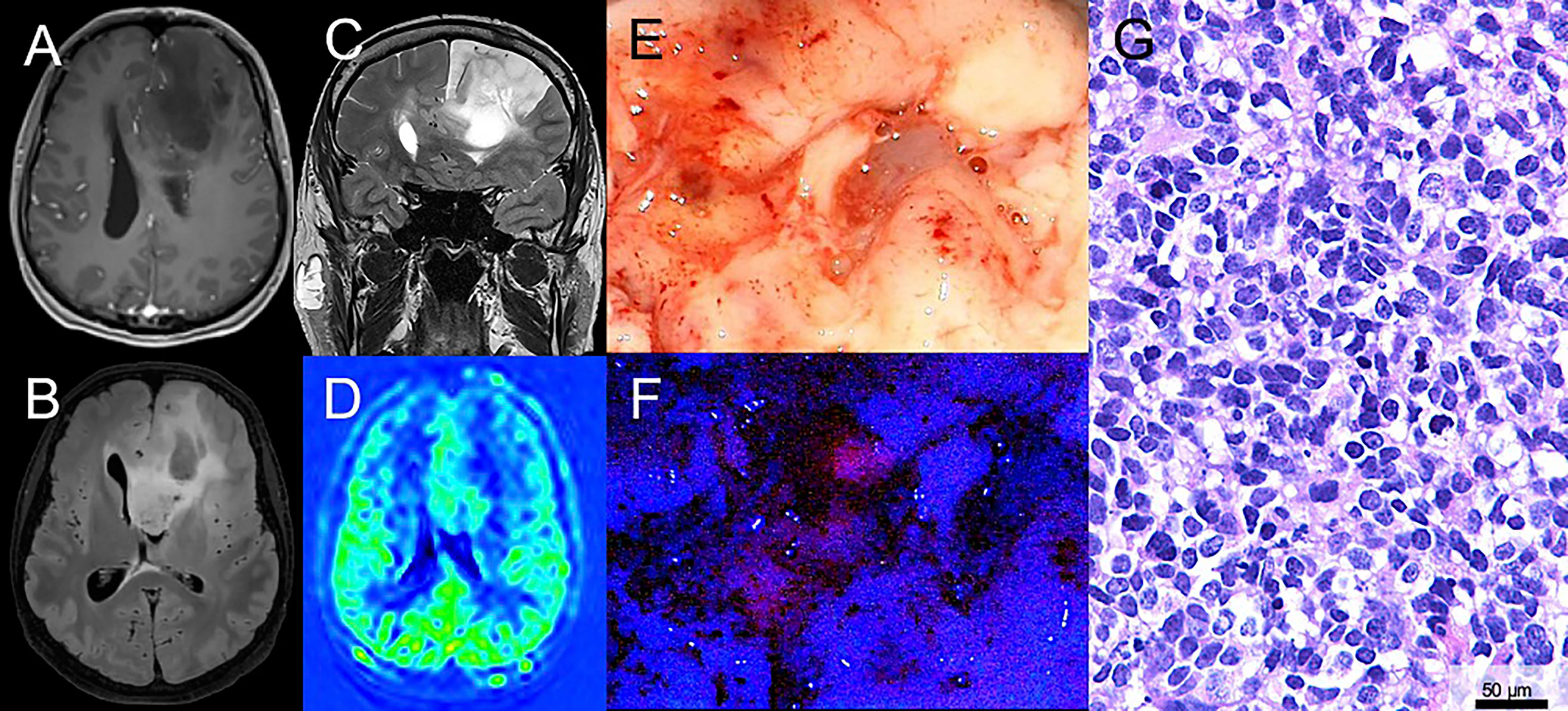 Frontiers 5 Ala In Suspected Low Grade Gliomas Current Role