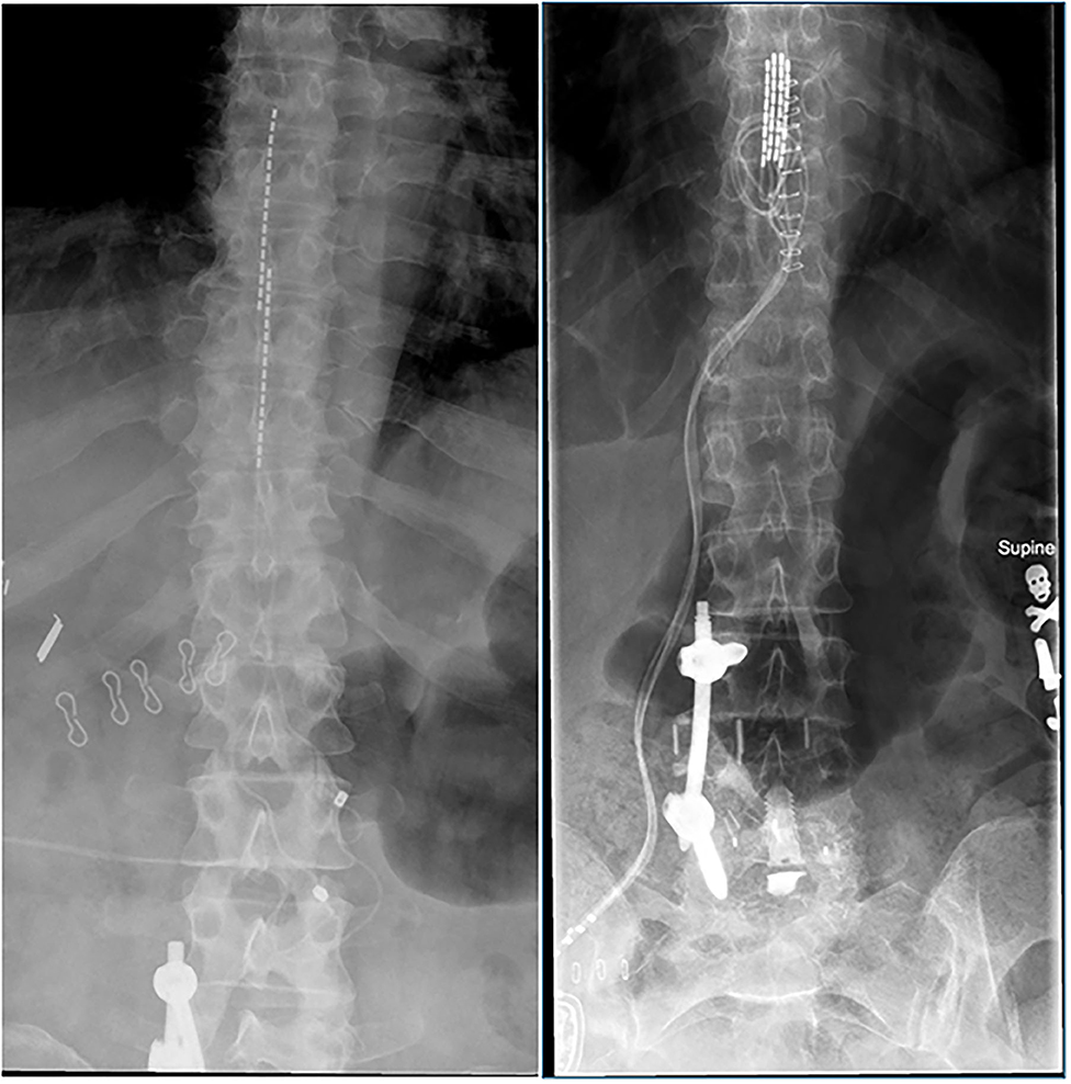 Spinal Cord Stimulator Implant