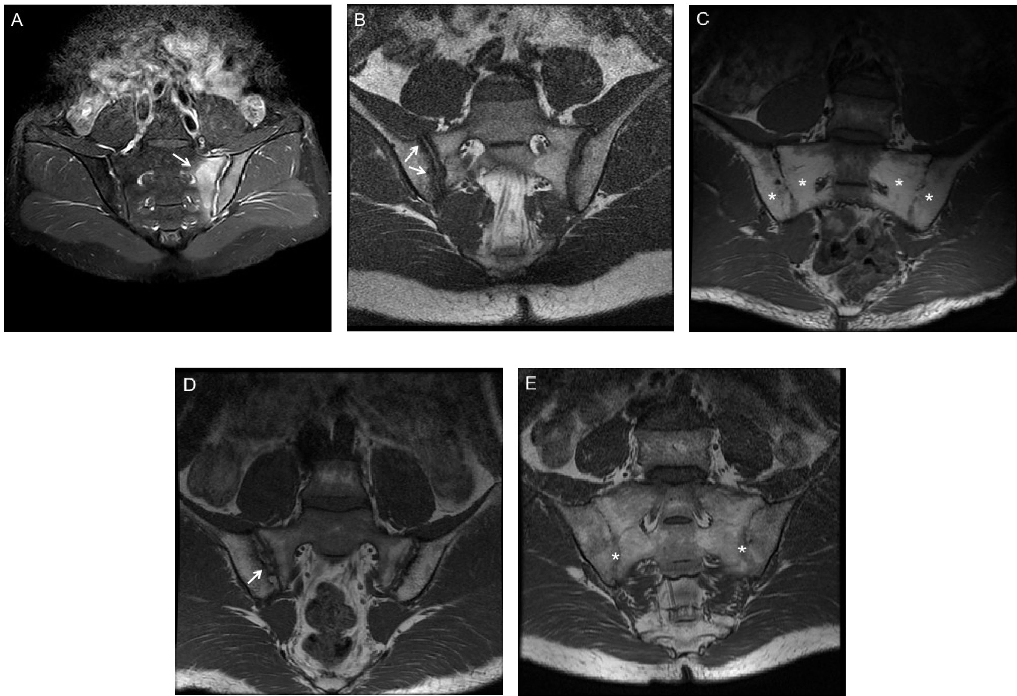 Frontiers | Active Inflammatory and Chronic Damages of Sacroiliac Joint in Patients With Radiographic Axial Spondyloarthritis and Non-Radiographic Axial Spondyloarthritis