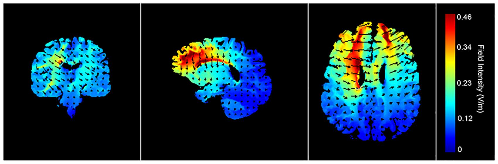 Frontiers  Modulating OFC Activity With tDCS Alters Regret About Human  Decision-Making