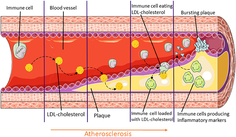 Figure 1 - In atherosclerosis, LDL-cholesterol (“bad” cholesterol) and immune cells enter blood vessel walls and form build-ups called plaques.