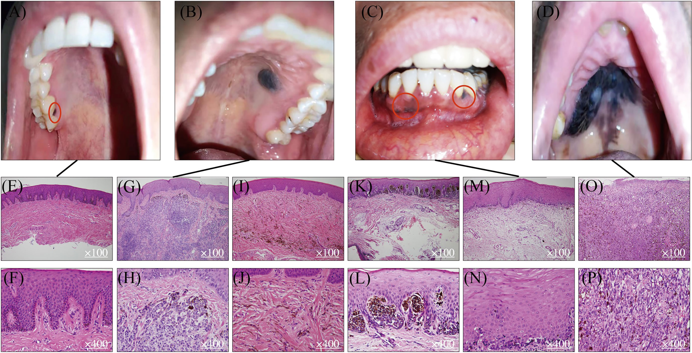 what causes canine oral melanoma