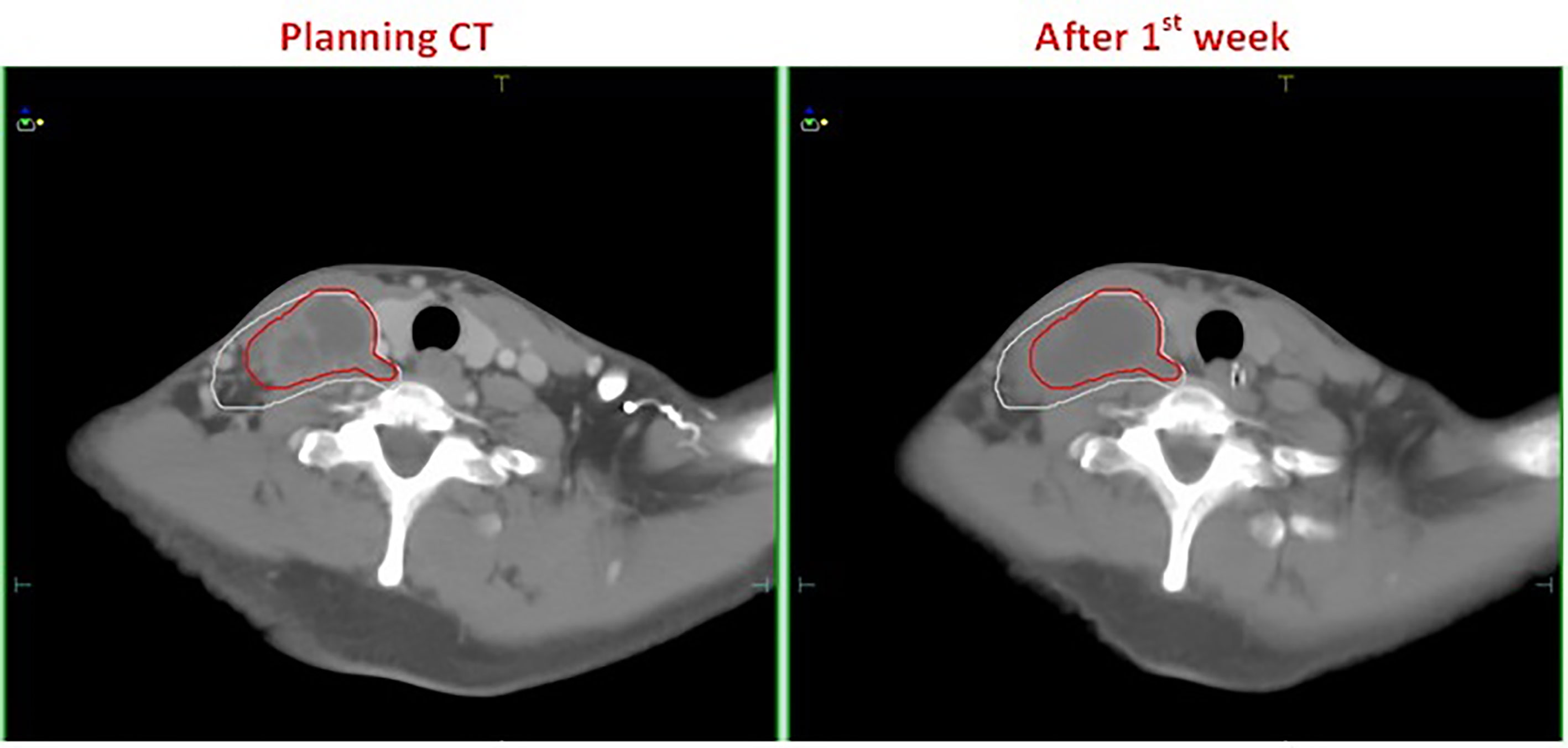 Impact of Neuroradiology-Based Peer Review on Head and Neck Radiotherapy  Target Delineation