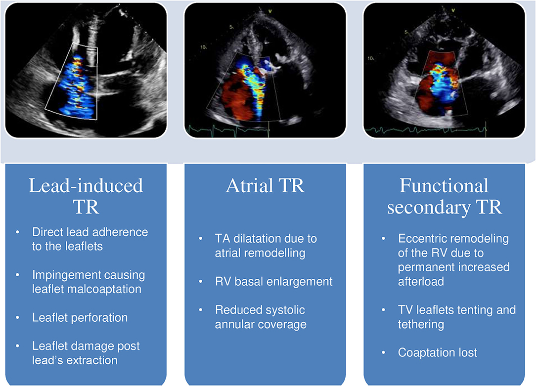 Left ventricular hypertrophy - Symptoms and causes - Mayo Clinic